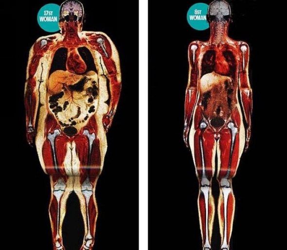 扫描照片显示脂肪之害:腹部堆积脂肪导致抑郁