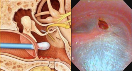 医生都叫别掏耳朵!真的不怕耳屎堵住吗?我看过视频