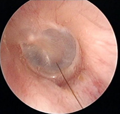 医生都叫别掏耳朵!真的不怕耳屎堵住吗?我看过视频