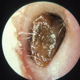医生都叫别掏耳朵!真的不怕耳屎堵住吗?我看过视频