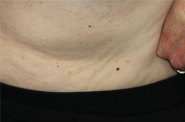 身上突然长的小红点 到底是什么东西啊?会癌变吗?