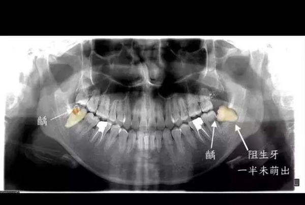 男子一次拔牙23颗后不幸离世 一次只能拔一颗吗?