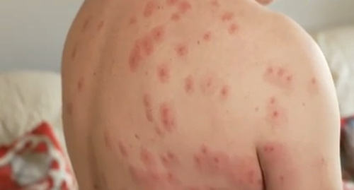 被黄蜂群蜇了240次都没死!这老哥要进化成黄蜂侠了