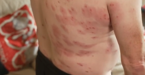 被黄蜂群蜇了240次都没死!这老哥要进化成黄蜂侠了