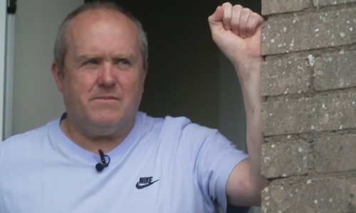 被黄蜂群蜇了240次都没死!这老哥要进化成黄蜂侠了