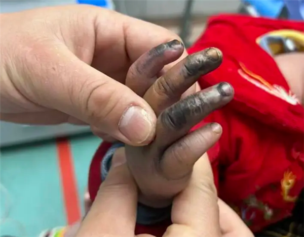 1岁宝宝误触充电口手指瞬间焦黑:曾有多人中招