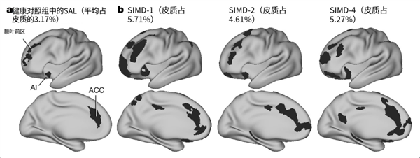 抑郁症病人的大脑到底发生了什么 真相惊人