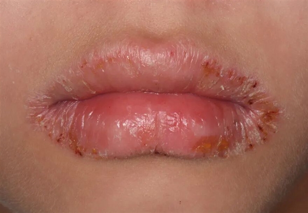 嘴唇总是干裂、起皮:可能不是水喝少了 而是得了这种病!