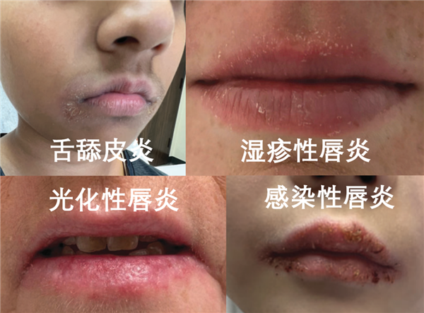嘴唇总是干裂、起皮:可能不是水喝少了 而是得了这种病!