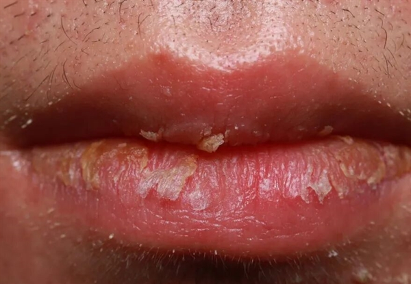 嘴唇总是干裂、起皮:可能不是水喝少了 而是得了这种病!