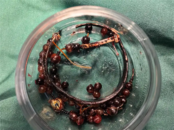 33岁女子戴手镯10年不摘：长胖后嵌进肉里严重感染