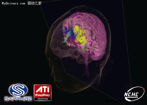 肿瘤早期发现 放射医学诊断等不可缺少的专业呈现利器--蓝宝科技ATI FirePro专业医疗显示卡