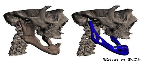 世界首例3D打印下颌移植手术细节公布