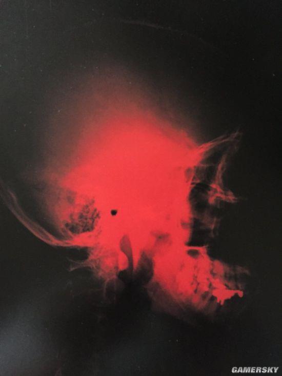 С�����ͷ�ǹǳ�ɶ�������Ȿ14��ǰ����