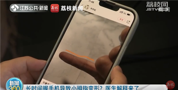 你的小拇指变形了吗？医生提醒：握手机要勤换姿势