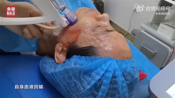 央视315曝光不可注射的美容针：10倍利润 或致毁容