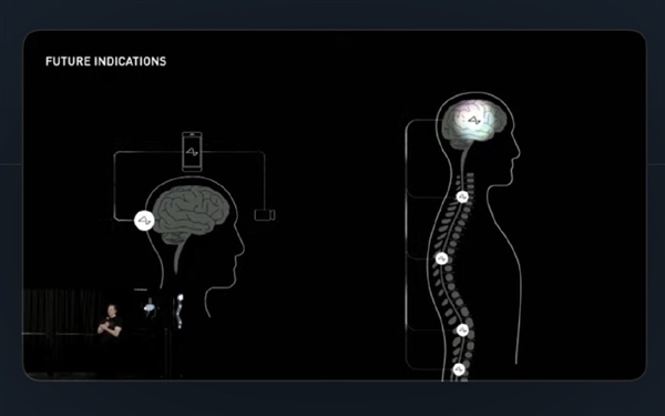 马斯克脑机接口迎重要进展：获准首次人体试验 曾让猴子用意念打游戏