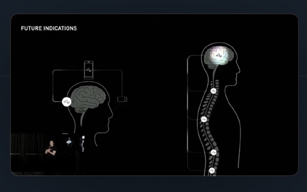 马斯克脑机接口获批人体实验 公司估值高达50亿美元